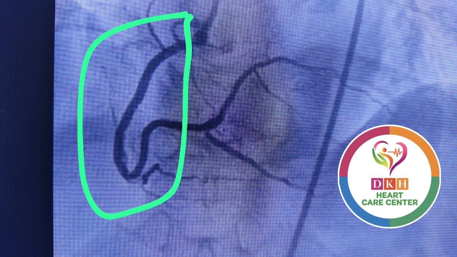 Medical Angiogram Image 2